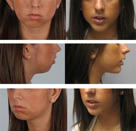 Chin Surgery Washington Dc Chin Implant Mclean Va