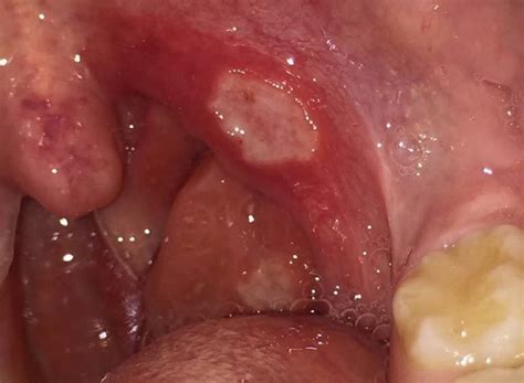 White Spots On Tonsils Treatment