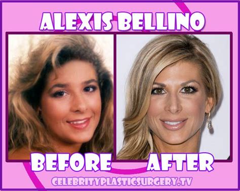 Celebrity Plastic Surgery Alexis Bellino Plastic Surgery
