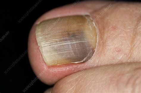 Fungal Infection Of The Toenail Stock Image C Science