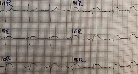 Acute Inferior Stemi With Right Ventricular Infarction And Cardiac