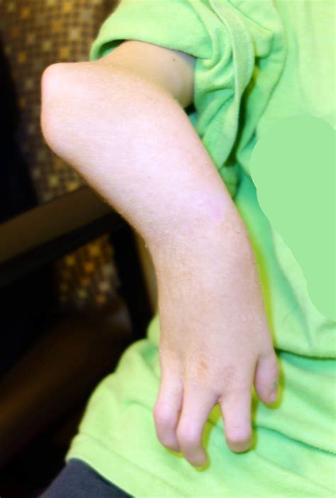 Congenital Hand And Arm Differences January 2014