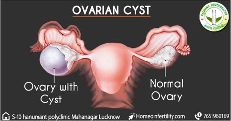How To Get Pregnant With Ovarian Cysts Dr R K Singh S Homoeopathic Infertility Center