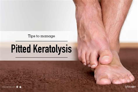 Tips To Manage Pitted Keratolysis By Dr Sandesh Gupta