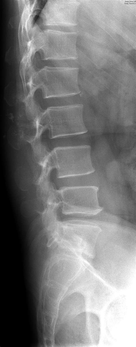 Plain Radiograph Reveals Stippled Calcification And Erosion Over The