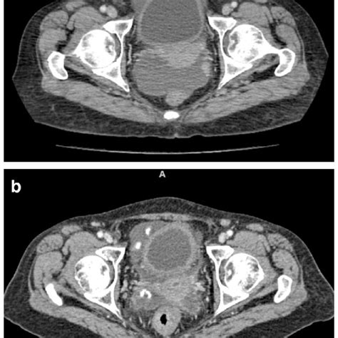 A Ct Scans Showing Groin Nodes B Post Chemotherapy Resolution Of Groin