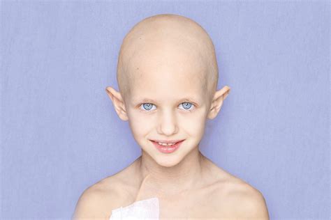 Cancer Child Portrait Świat Lekarza