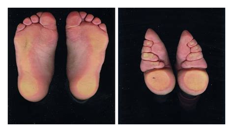 A Study On Bone Mass In Elderly Chinese Foot Binding Women
