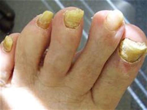 Common treatment option will include: Yellow Toenails | Content Injection