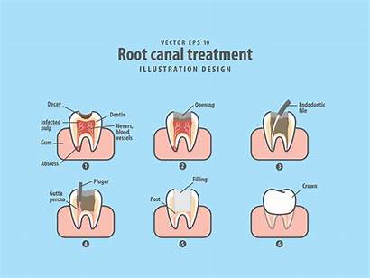 Treatment Canal Root Illustration Dental Vector Canals