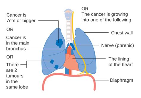 Early Definition And Symptoms Of Mesothelioma •