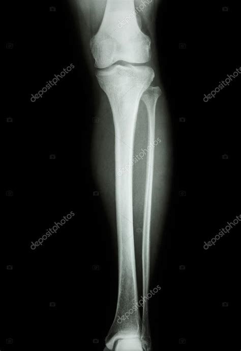 X Ray Of Leg Film X Ray Normal Humans Leg — Stock Photo © Stockdevil