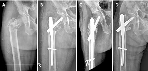 Does Proximal Femoral Nail Antirotation Achieve Better Outcome Than