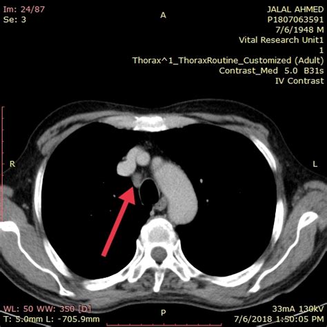 Lymphadenopahty At Right Hilum Of Lung Pretracheal Lymph Node Ct