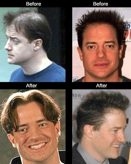Brendan Fraser Hair Transplant Celebrity Hair Transplants Before And