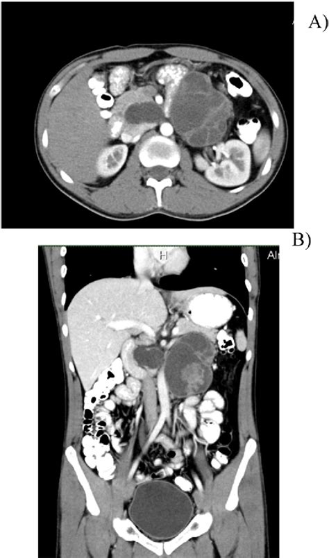 Figure 1 From Metastatic Testicular Retroperitoneal Teratoma In An