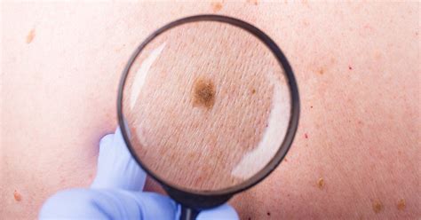 How To Spot This Potentially Deadly Skin Cancer Future Of Personal Health