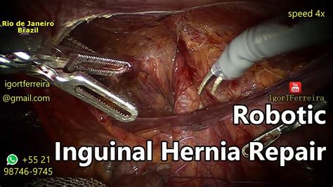 Robotic Umbilical Hernia Surgery Robotic Epigastric Hernia Repair