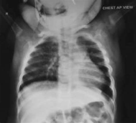 Follow Up Chest X Ray One Month After Surgery Download Scientific Diagram