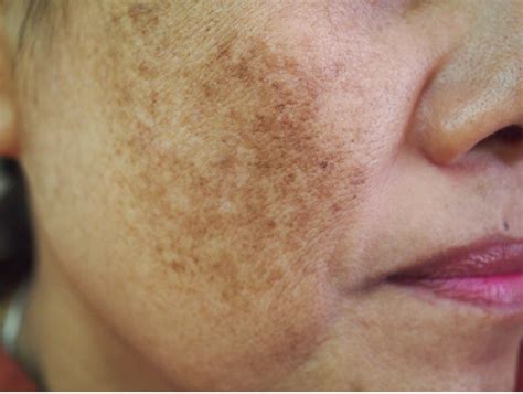 Melasma Craig Singer Md Dermatology