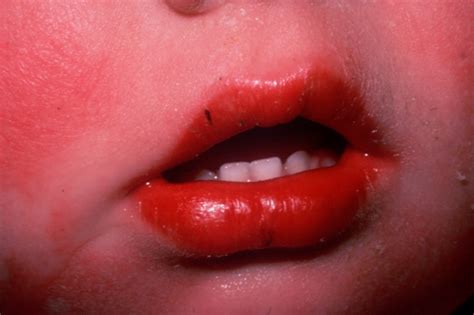 What Causes Fever Rash On The Lips