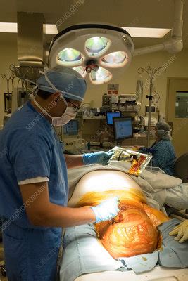 Scrotal Hernia Surgery Stock Image C033 6063 Science Photo Library