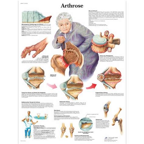 Arthrose Arthrose Deformante Osteoarthrose