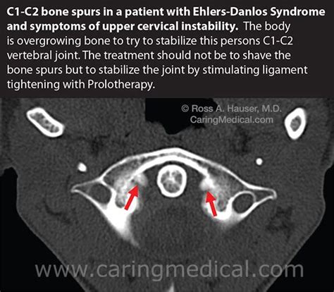 Cervical Bone Spur Mri Ehlers Danlos Syndrome Cervical Syndrome