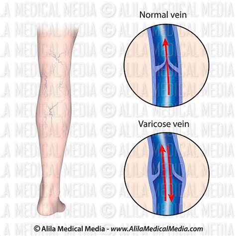 Alila Medical Media Varicose Veins Medical Illustration