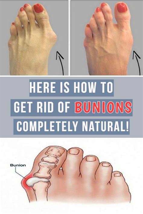 How can we get rid of the black birds? #bunions in 2020 | Get rid of bunions, How to get rid ...