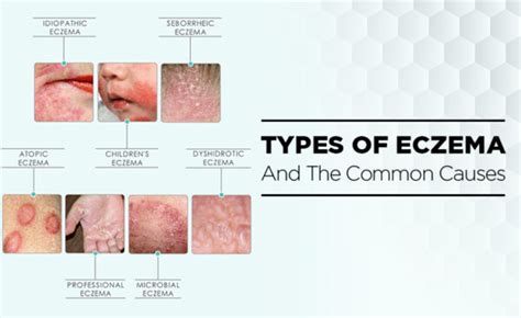 Different Types Of Eczema And Its Common Causes