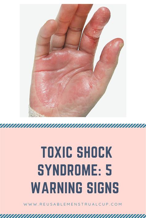 Tss 5 Warnings Signs How Do I Know If I Have Toxic Shock Syndrome