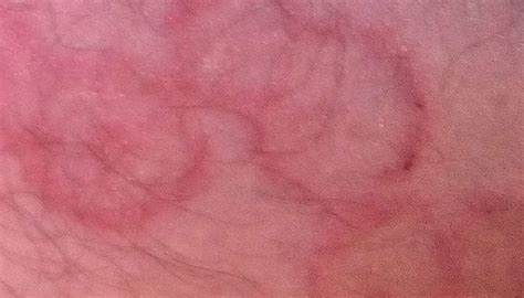 Nummular Eczema Vs Ringworm Symptoms Causes And Treatment