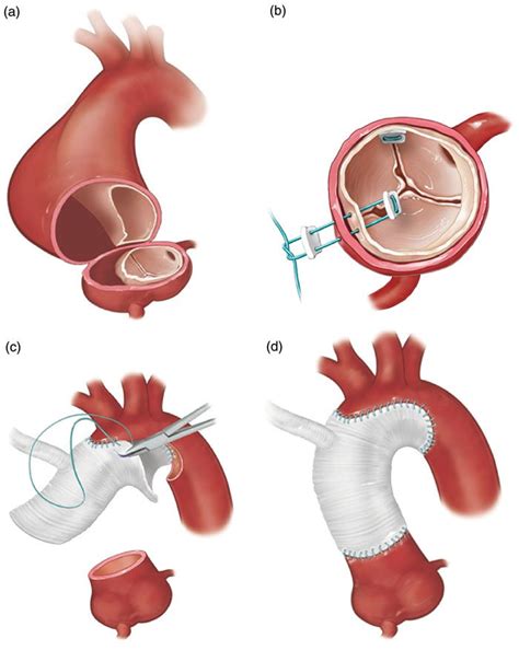 Aortic Valve And Ascending Aorta Replacement