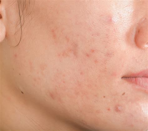 Non Medicamentous Options For Treatment Moderate To Severe Acne And