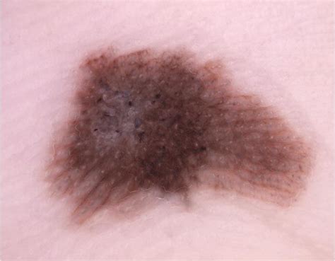 Acral Melanoma Dermatoscopic Image Of An Acral Melanoma With Asymmetry