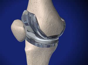 Le but de cette opération est de remplacer par une prothèse, votre genou ou la partie de votre genou endommagée par l'arthrose. Prothèse totale du genou : restaurer sans douleur la ...