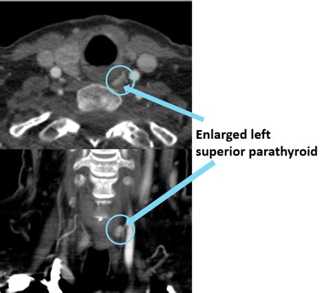 Parathyroid Imaging And Ultrasounds Saint John S Cancer Institute