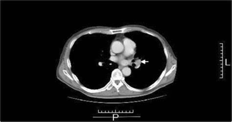 Chest Computed Tomography On 31 August 2010 Swelling Of A Lymph Node