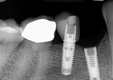 Why Implant Restoration Screws Become Loose Spear Education
