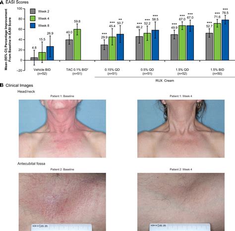 Treatment Of Atopic Dermatitis With Ruxolitinib Cream Jak1jak2