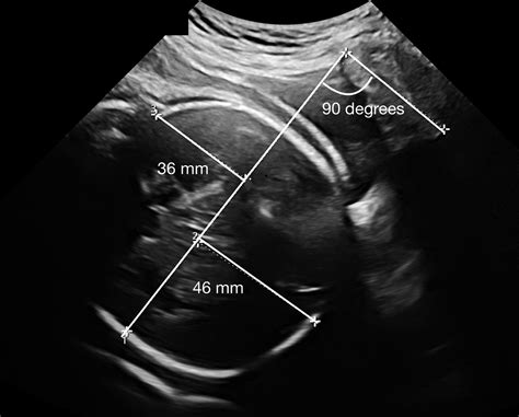 Increased Diagnostic Accuracy Of Fetal Head Station By Use Of