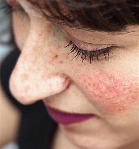 Blotchy Skin Or Rosacea Whats The Difference 100 Pure