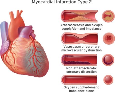 Acute Myocardial Infarction A Shifting Paradigm Recapem