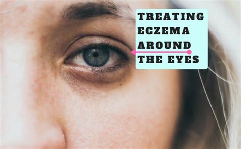 Treating Eczema Around The Eyes Natural Remedies