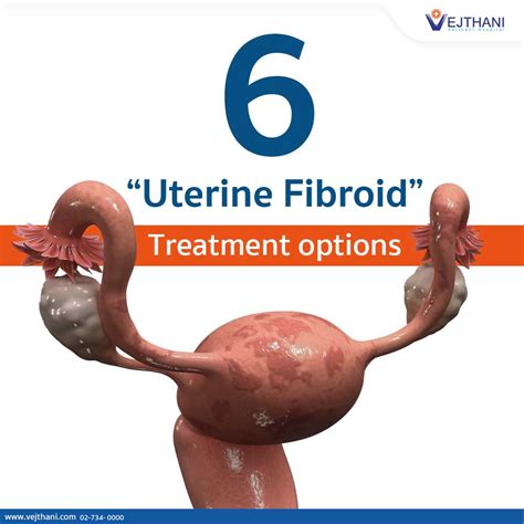 10 Cm Uterine Fibroid