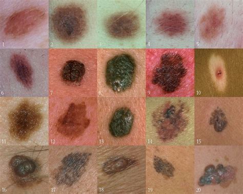 Types Of Skin Cancer Remember Abcd For Asymmetry Border Colour And