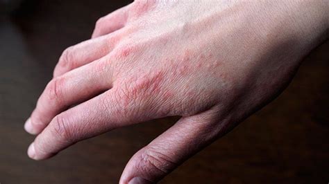 Reduce Indoor Allergens To Improve Your Eczema Everyday Health