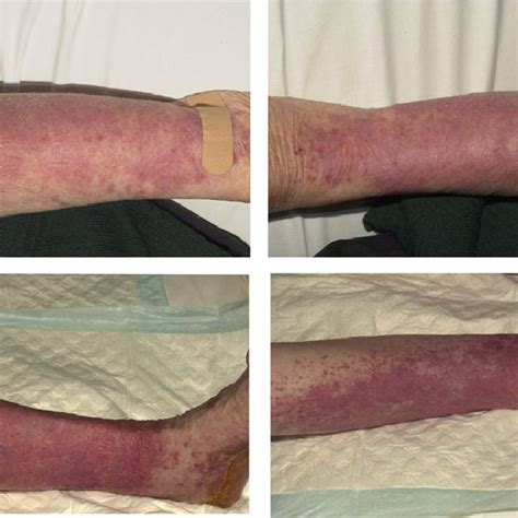 Drug Related Skin Eruptions In Patients With Rheumatoid Arthritis Ra