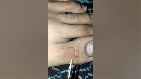 169 Toe Hairs Plucking Thick Hairs Removal Fast Plucking Hairtiktok